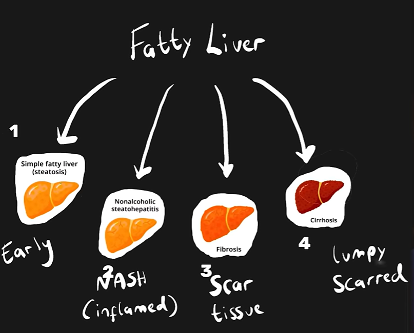 지방간 없애는 방법