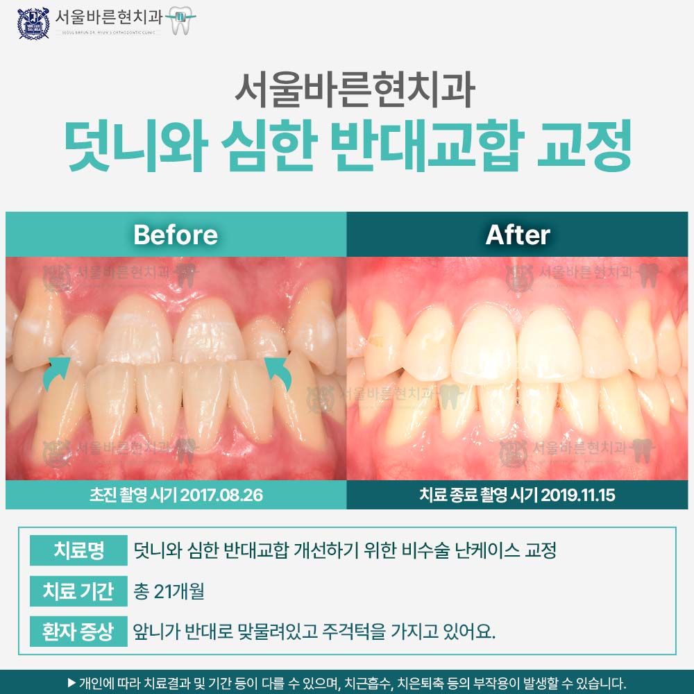 부산치아교정