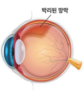 망막박리 증상, 원인, 치료 방법