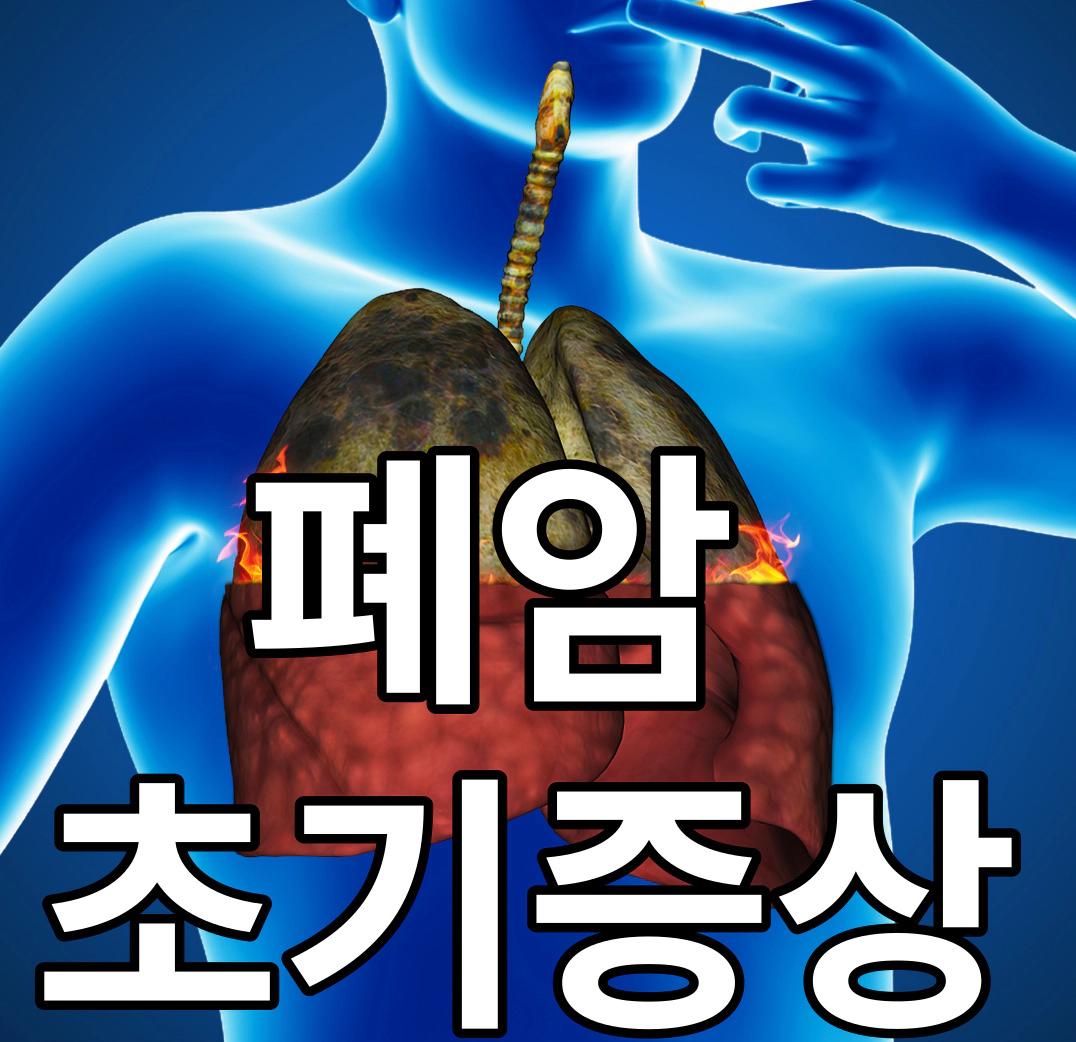 폐암&nbsp;초기증상-진료과