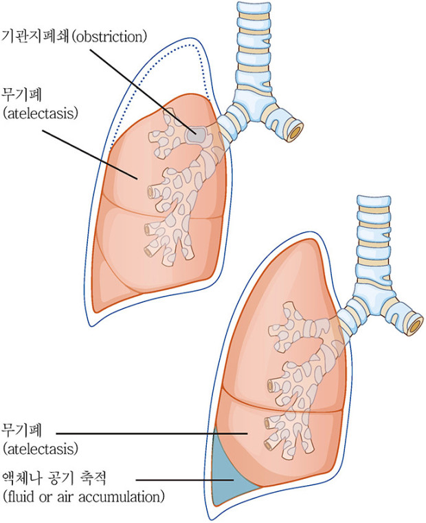 무기폐에 대하여/ 출처 - 네이버 백과사전