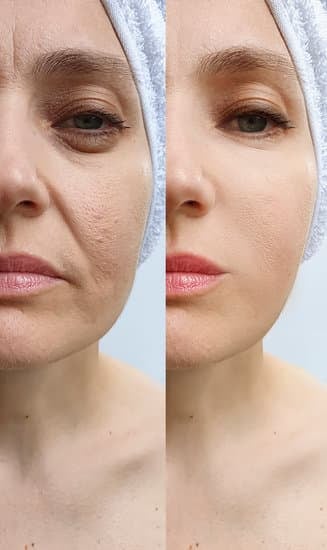 마리오네트 주름 없애는 방법: 원인과 효과적인 치료법