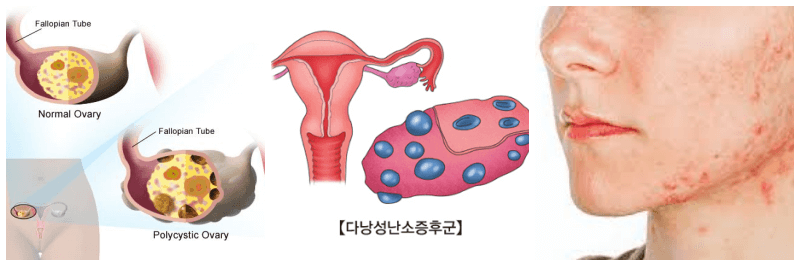 다낭성 난소 증후군 관련 사진 3개