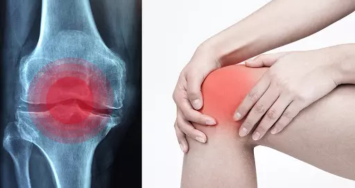 관절염 (Arthritis)