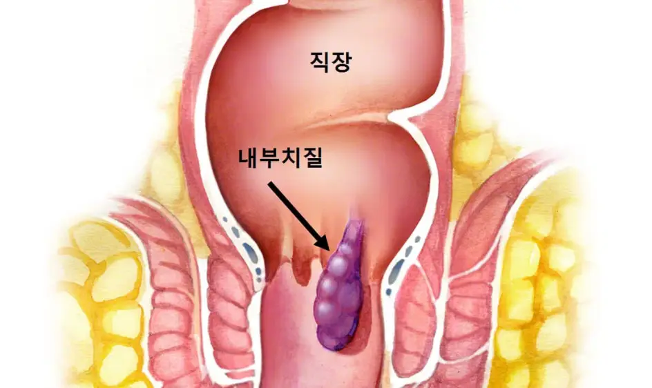 치질 증상과 예방법