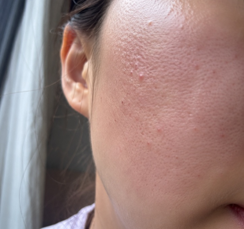 물광주사 시술 전 붉은 기와 좁쌀 트러블이 올라온 예민한 민감성 피부 결 초근접 원본 상태