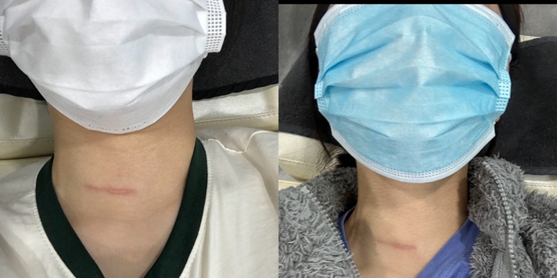 흉터치료 전 후 사진