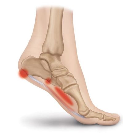 족저근막염(사진 : Pinterest)