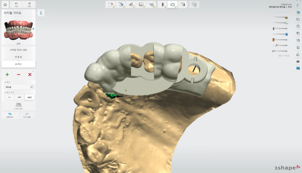 네비게이션 임플란트는?