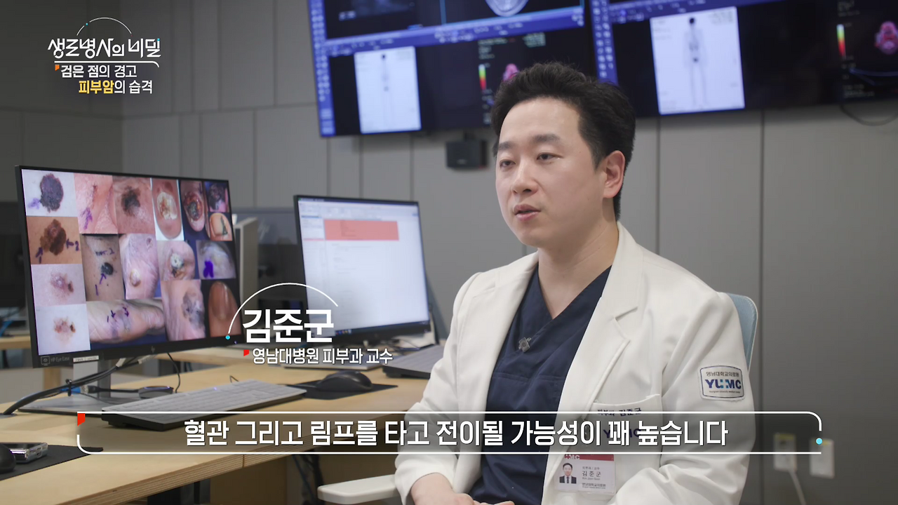 생로병사의 비밀 피부암 검은점