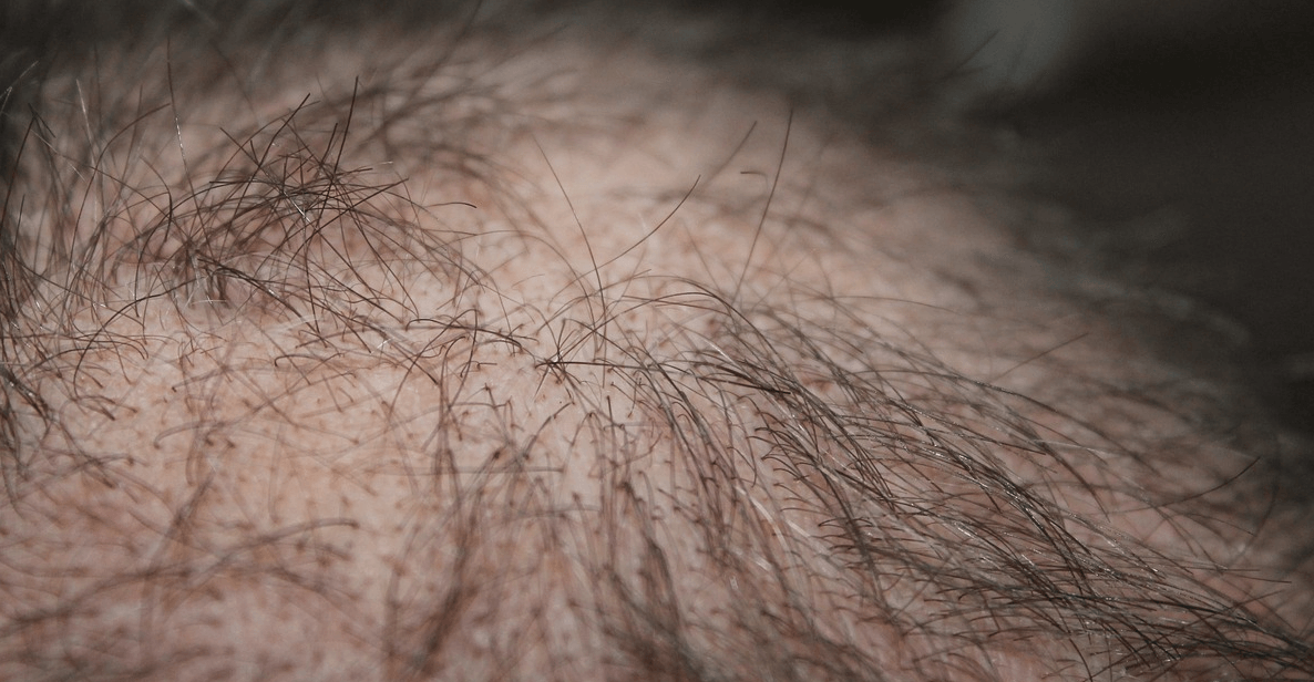 철분 부족 증상과 관련된 사진 - 11