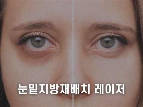눈밑레이저