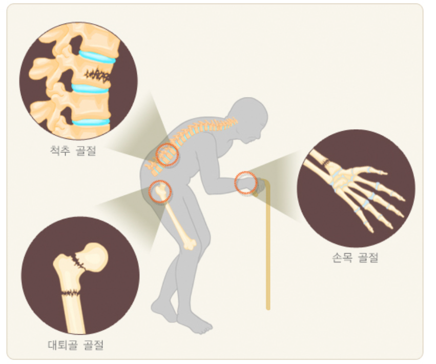 골절이 잘 되는 부위