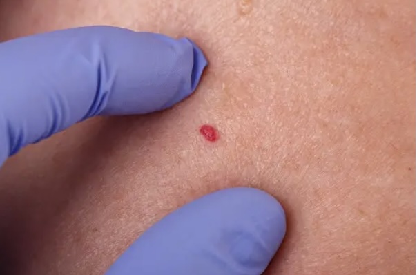 손가락혈관종: 원인, 증상 및 관리 방법 예방