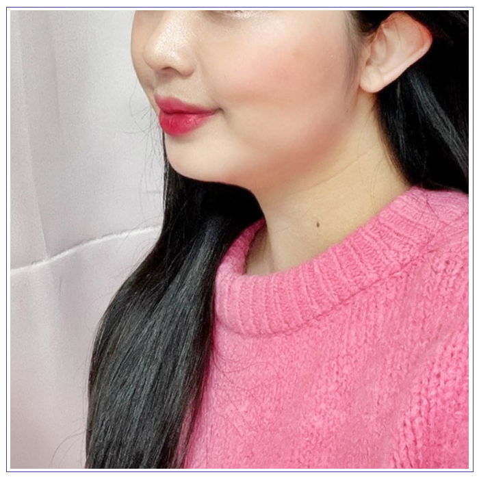 윤곽주사 후기