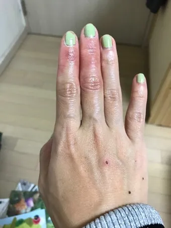 에로콤크림 코르티코이드 반응성 피부질환에서의 염증가려움 완화 전략에 대한 사용수칙_8