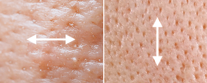 모공 개선 효과