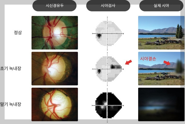 녹내장구분