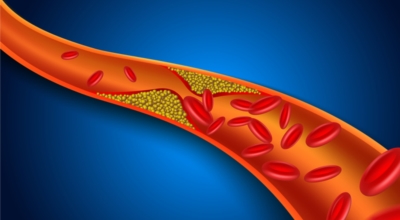 콜레스테롤 이미지