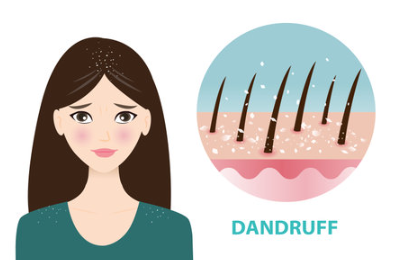 지루성두피염 탈모 샴푸 7가지 선택 기준, 전문의가 알려주는 진실
