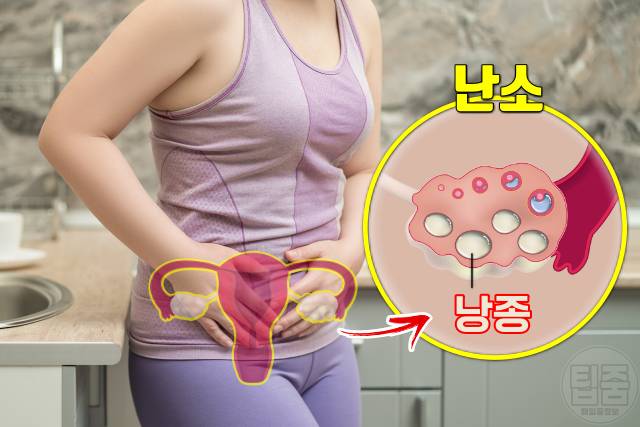 다낭성난소증후군 증상 자가진단 난소 낭종 여자 살찌는병