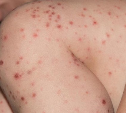 수족구 질병 사진입니다.