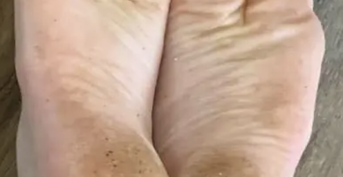 하지 정맥류 증상 34