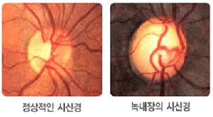 정상적인 시신경과 손상된 시신경의 비교사진