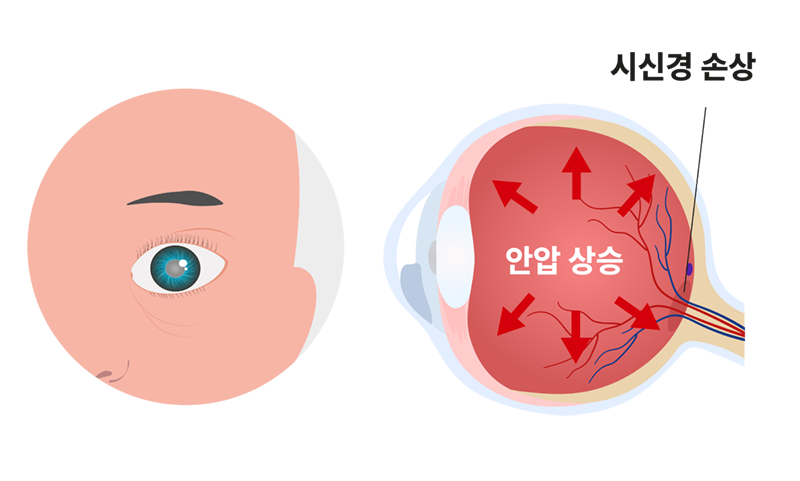 안압 상승으로 인해 안구 뒤쪽의 시신경이 압박을 받아 손상되는 과정을 설명하는 일러스트레이션