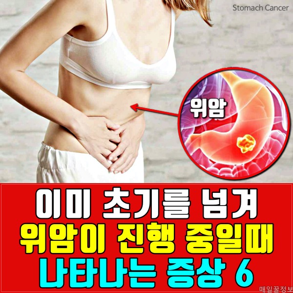 위암 초기 증상 위암 진행 중,건강 팁줌 매일꿀정보