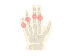 손가락 관절염 초기증상