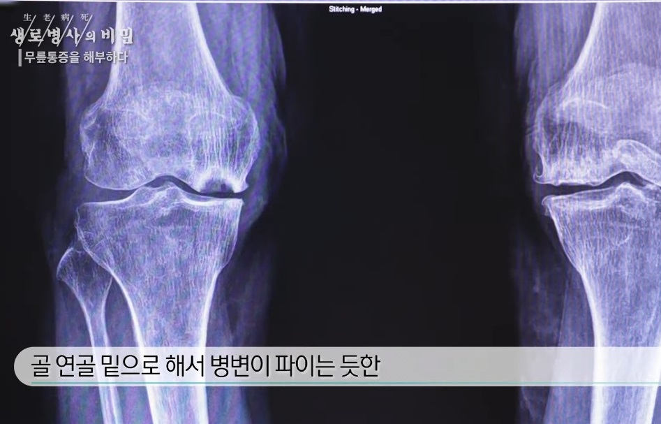 퇴행성-무릎-관절염