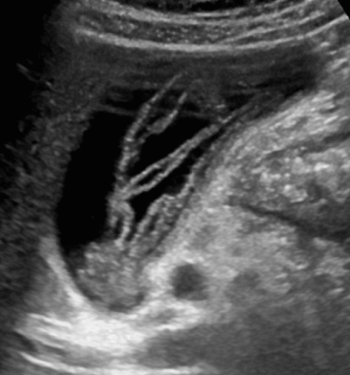 회충증 (Ascariasis)