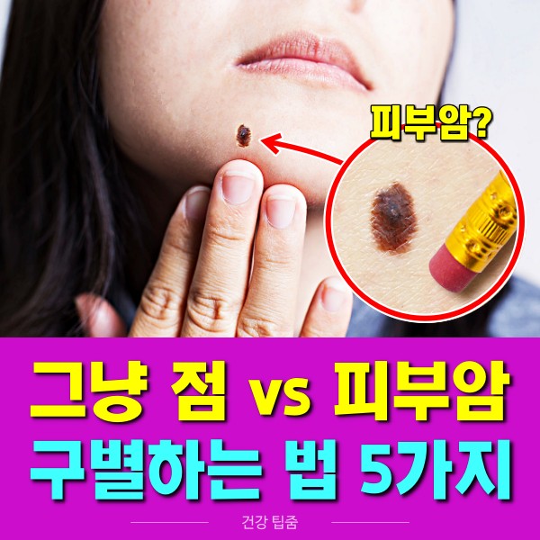얼굴 점 피부암 증상 가려운 점 튀어나온 점,팁줌