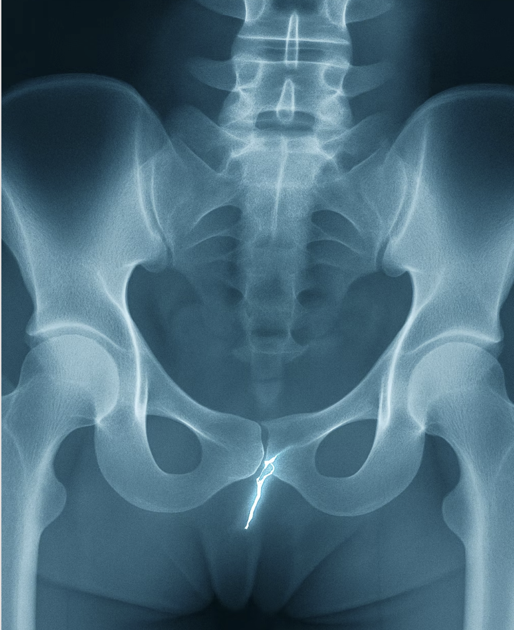 단순 타박상 vs 꼬리뼈 골절