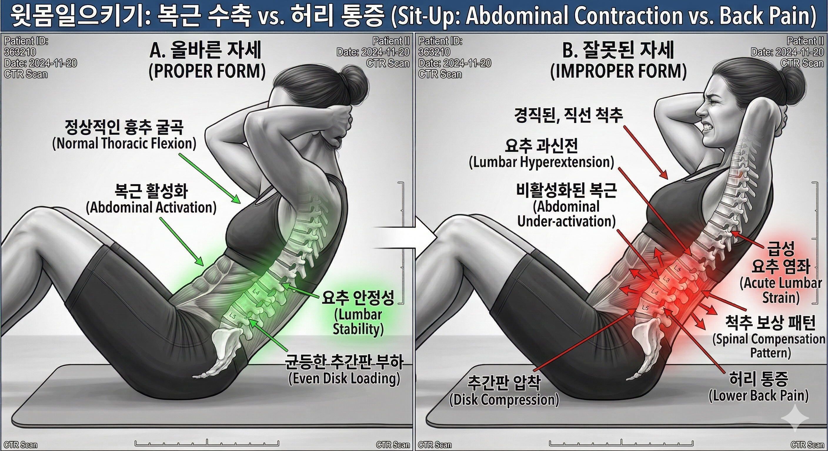 윗몸일으키기 허리 통증 잘못된 복근 운동 자세 요추 과굴곡