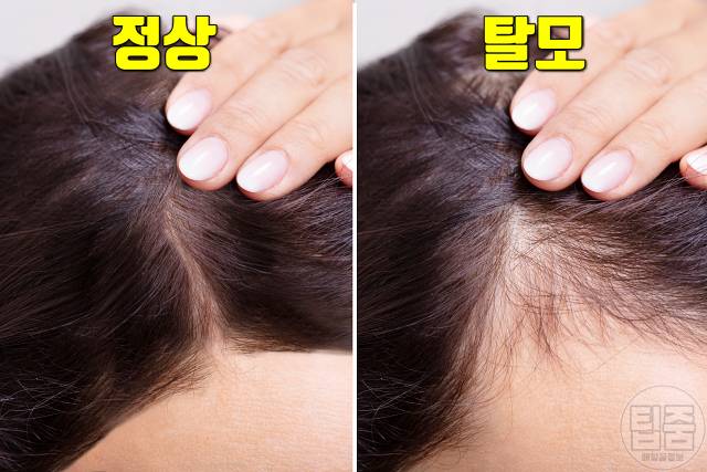 여자 탈모 자가진단 탈모초기증상