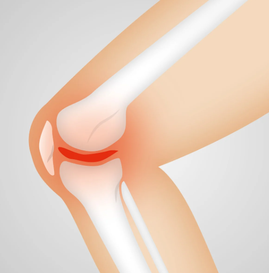 콘드로이친과 관절염