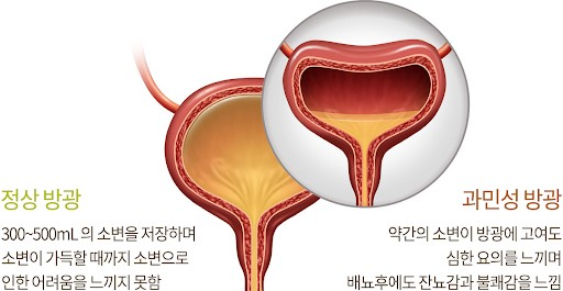 과민성 방광 치료에 사용되는 베시케어정5MG