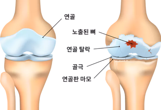무릎-관절염에-좋은-운동-주의사항