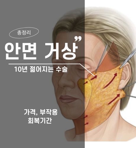 안면 거상 총정리