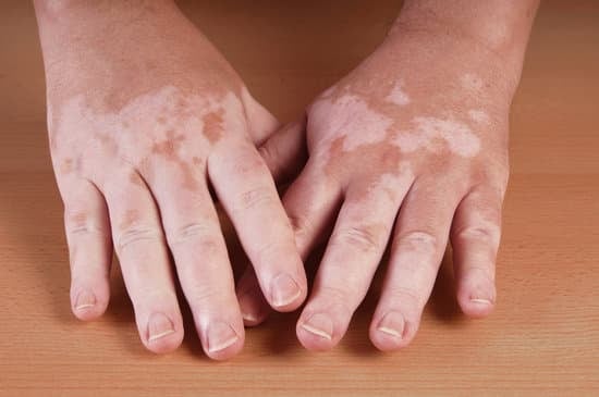 백반증(Vitiligo)과 색소 침착(Hyperpigmentation): 차이점 및 관리법