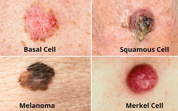 피부암 종류별 초기증상 10가지