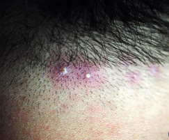 지루성 두피염 증상5