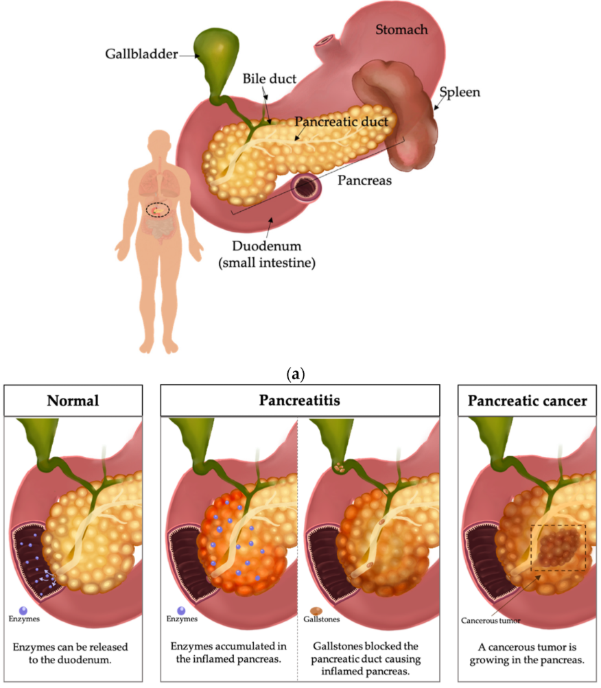 췌장암 조기 발견의 중요성과 생존율 관련 이미지