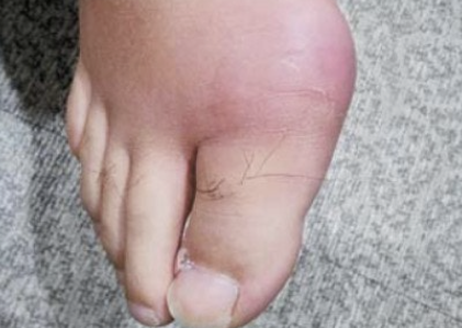 통풍 증상&amp;#44; 이렇게 아플 줄 몰랐어요