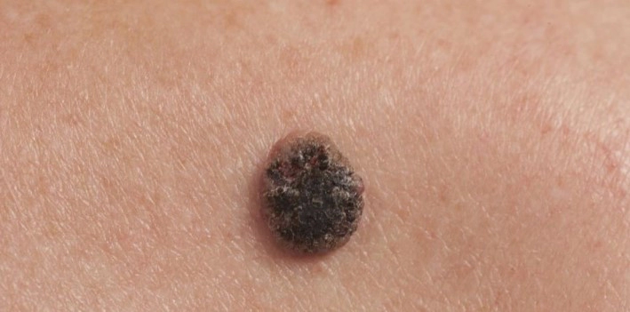 흑색종 치료법과 예후