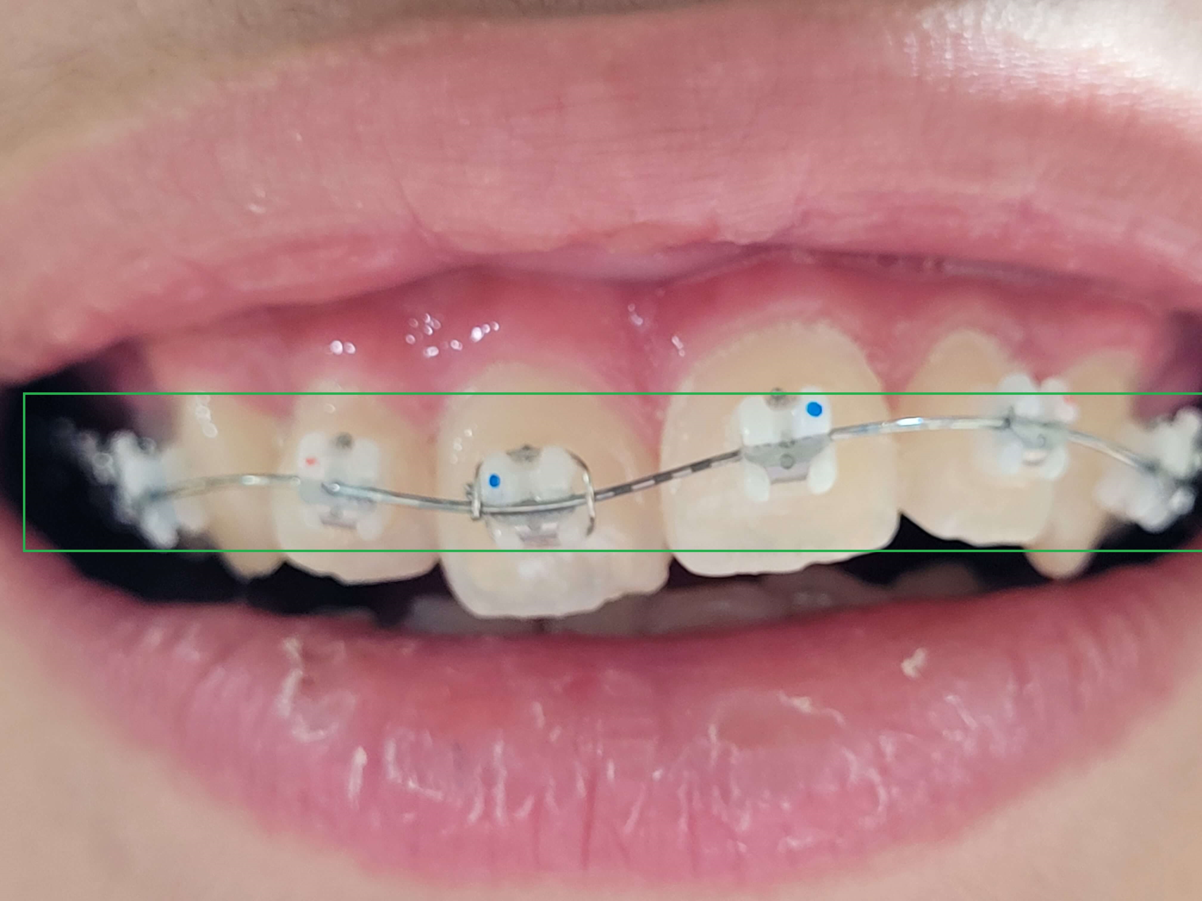 부정교합 가위교합 과개교합 치아교정 후기15