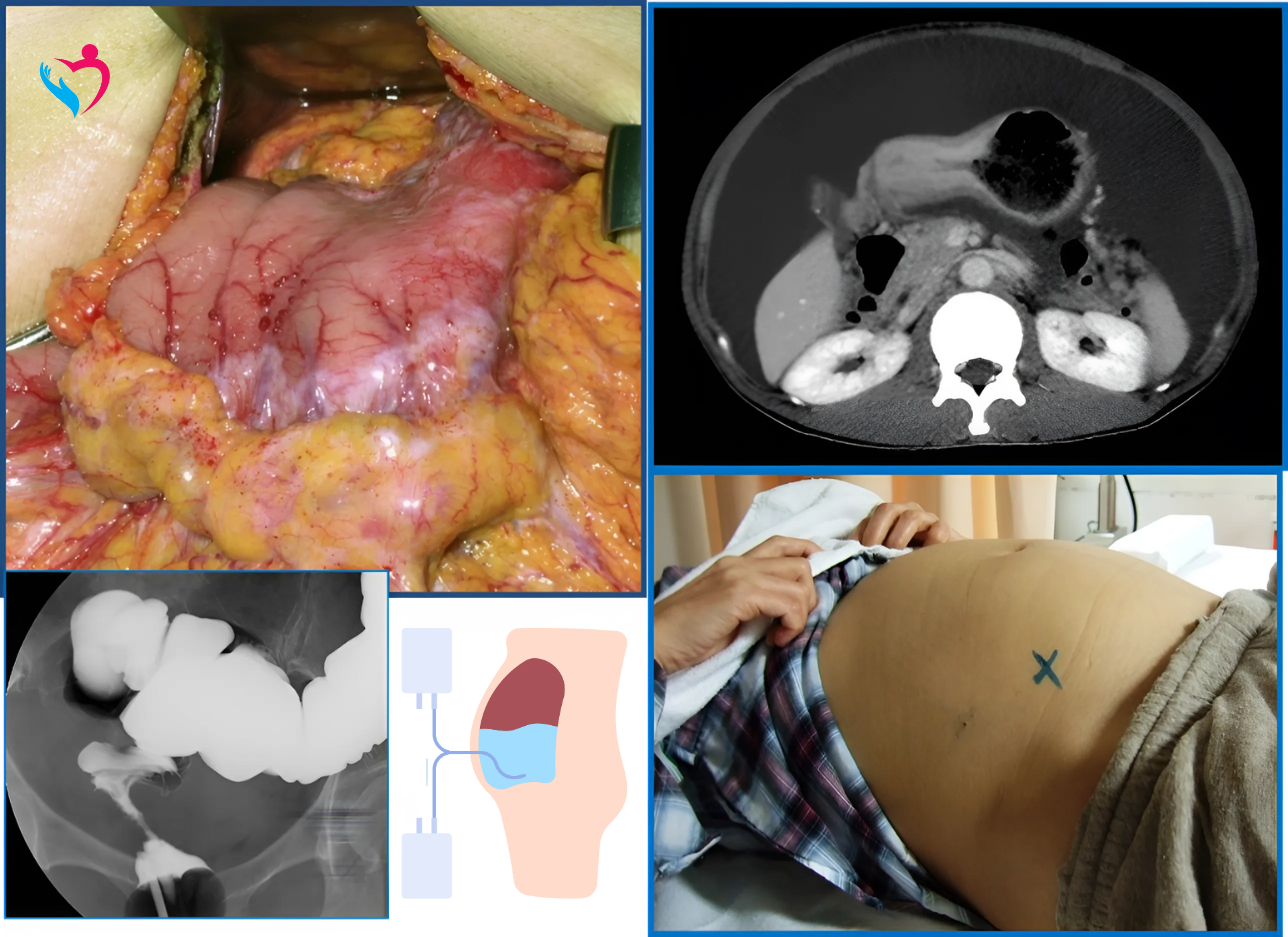 복막파종 전이 복강항암제 치료