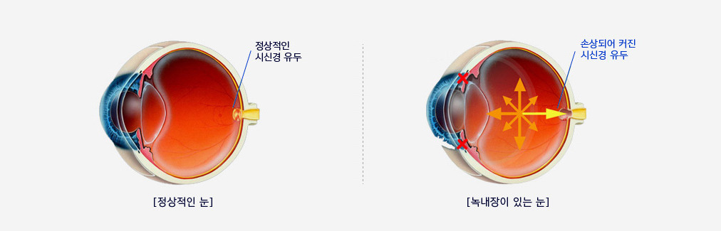 녹내장 수술 비용&amp;#44; 초기증상